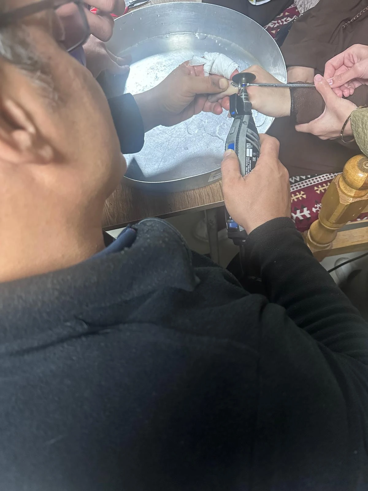 BATMAN PARMAĞINA SIKIŞAN Y&Uuml;Z&Uuml;K HASTANEDE &Ccedil;IKARILDI