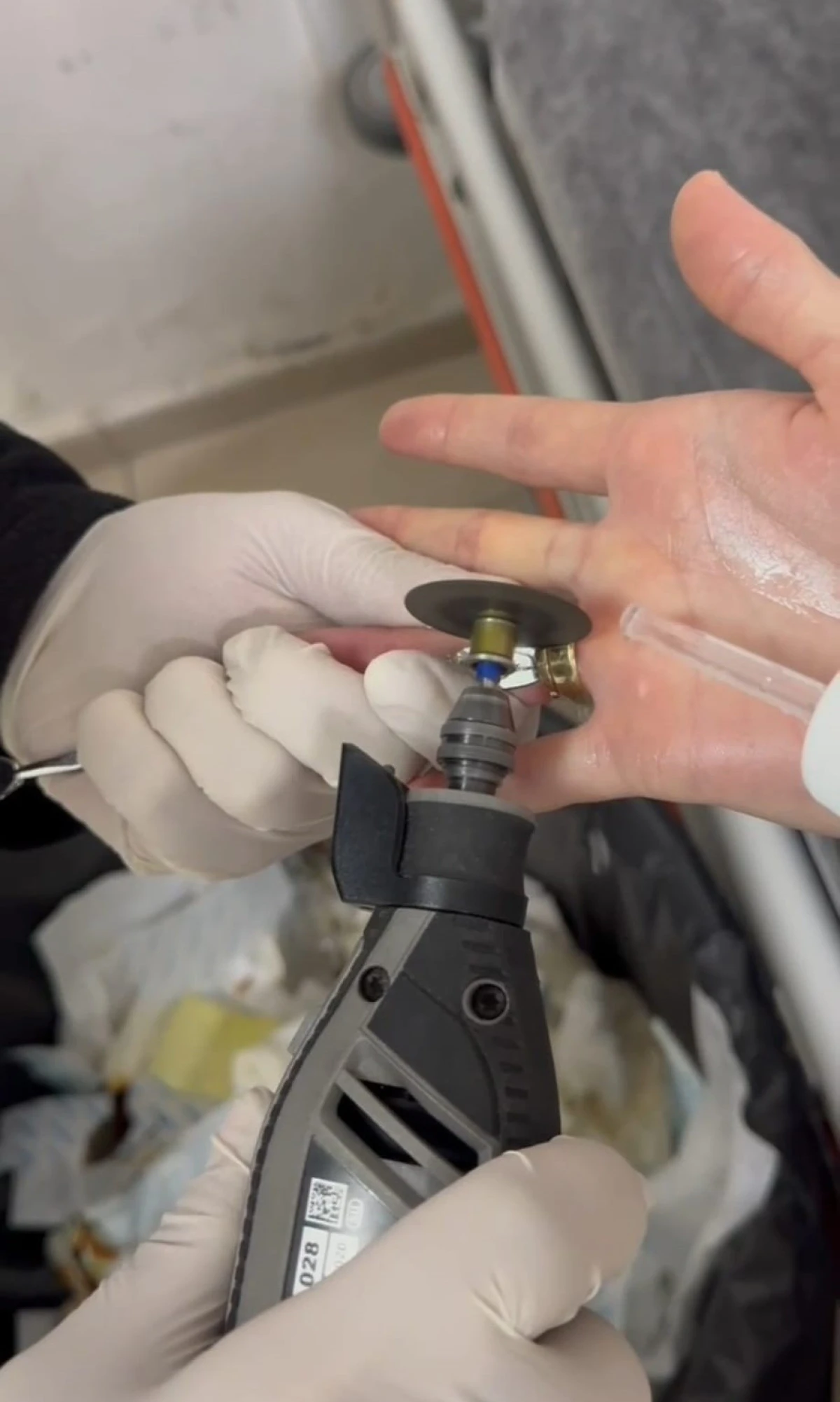 BATMAN’DA PARMAĞA SIKIŞAN İKİ YÜZÜK 'SPİRAL MAKİNE' İLE ÇIKARILDI